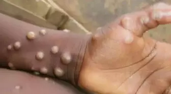 Madagaskar'da ilk defa M çiçeği vakası tespit edildi