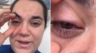 Bulaşık makinesi tableti kadının gözüne patladı, kör olma korkusu yaşadı