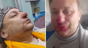 Onur Akay, başıboş pitbull köpeğinin saldırısında yaralandı