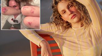 Farah Zeynep Abdullah'ın vücudundaki morluklar korkuttu