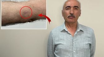 Kolundaki 1 santimetrelik yara kanser çıktı