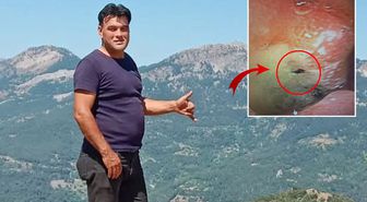 Kabus gibi olay! Midesinden canlı böcek çıkarıldı