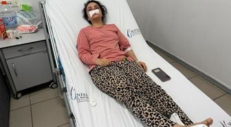 Eşinin ısırarak burnunu kopardığı kadının geldiği hale bakın