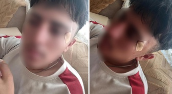 İddia vahim! Öğretmenin kafa attığı çocuğun burnu kırıldı