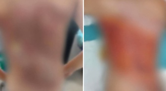 Arnavutköy'de akran zorbalığı iddiası: 12 yaşındaki çocuğun sırtını kolonya ile yaktılar