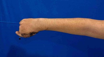 Kasapta kıyma makinesine 5 parmağını kaptıran 13 yaşındaki çocuğun ayak parmağı eline nakledildi