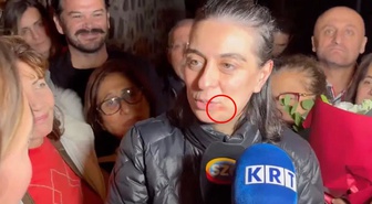 Sinem Dedetaş'ın dudağının kenarındaki kızarıklığın nedeni belli oldu