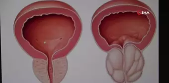 İyi Huylu Prostat Büyümesi Tedavisinde HoLEP Ameliyatı ile Yeni Bir Dönem