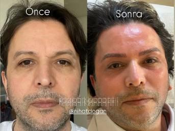 Uzsun süredir ekranlardan uzak kalan Nihat Doğan estetikle bambaşka birine dönüştü