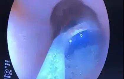 Midesindeki 9 pil, endoskopik yöntemle çıkarıldı