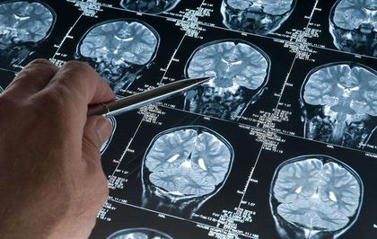 Araştırma: Alzheimer düşünüldüğünden daha erken başlayabilir