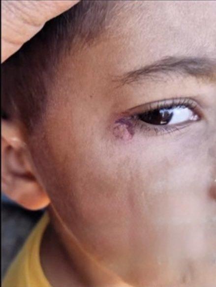 Okulda dehşet! Temizlik görevlisi minik Mustafa'nın yüzünde sigara söndürdü