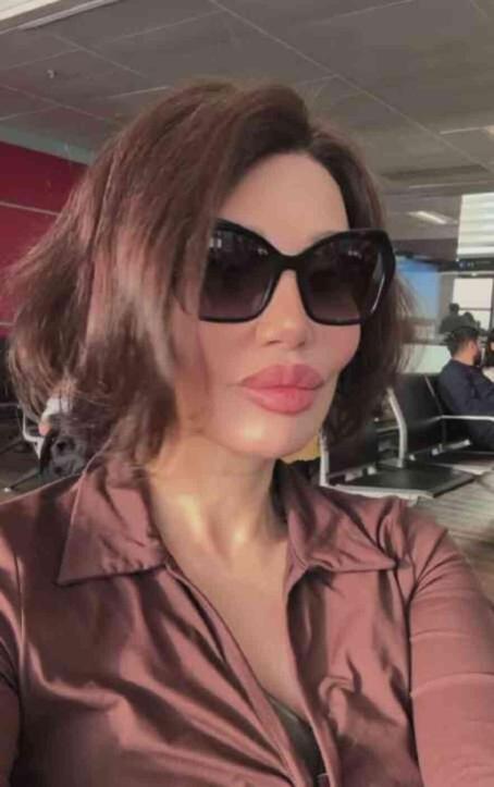 Alın daraltma ameliyatı olmuştu! Umut Akyürek'in son haline bir bakın