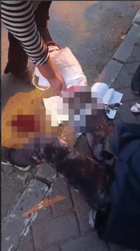 Ankara'da başıboş köpek vahşeti: Kadın akademisyenin yüzü ve bacağı parçalandı