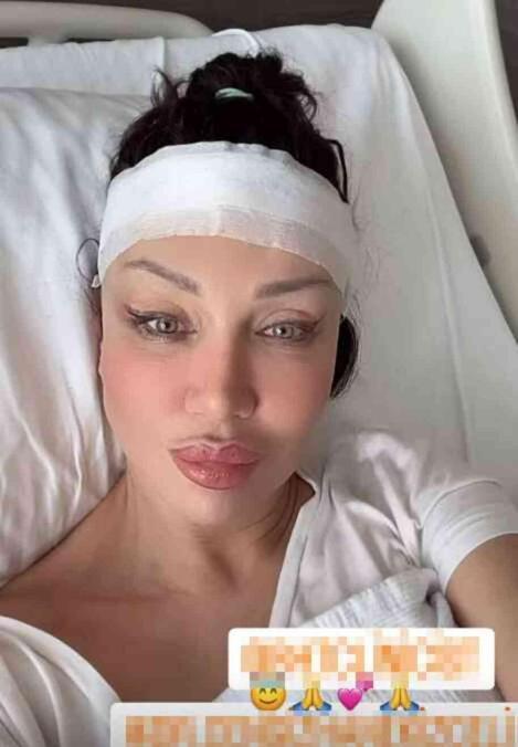 Alın daraltma ameliyatı olmuştu! Umut Akyürek'in son haline bir bakın