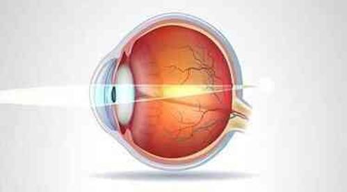 Hipermetrop nedir? Belirtileri ve tedavi yöntemleri nelerdir?