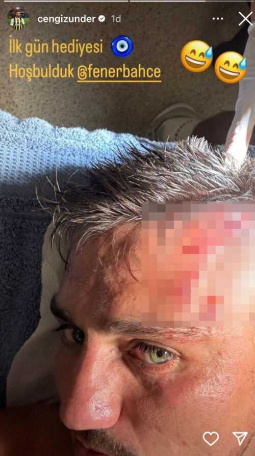 Cengiz Ünder sakatlandı mı, kafasına ne oldu?