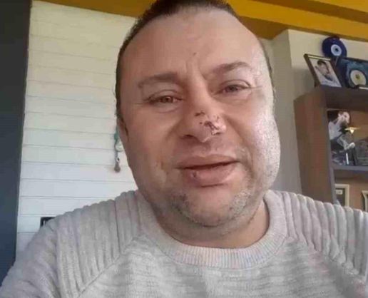 >Pitbull saldırısına uğrayan Onur Akay o anları anlattı: 