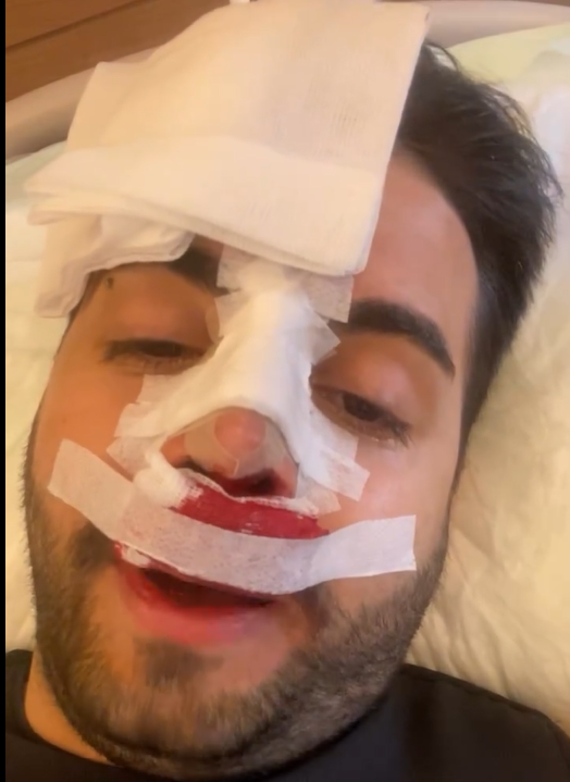 Kadir Ezildi burnu sargılı fotoğrafıyla korkuttu! Gerçek sonradan ortaya çıktı