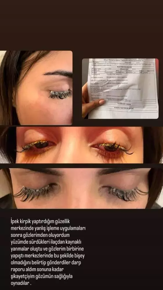 Güzelleşeyim derken az daha kör oluyordu