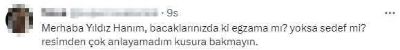 Mini etekli pozlarını paylaşan Yıldız Tilbe'nin bacaklarındaki lekeler sevenlerini korkuttu