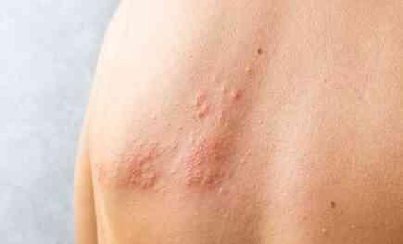 ZONA NEDEN OLUR? Zona (GECE YANIĞI) nedir, belirtileri neler?