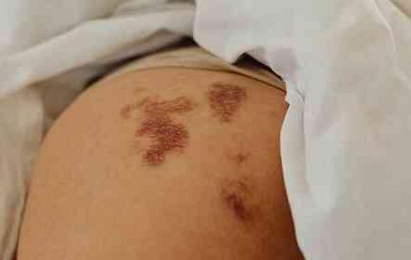 DOĞUM LEKESİ NEDEN OLUR? Doğum lekesi çeşitleri neler?