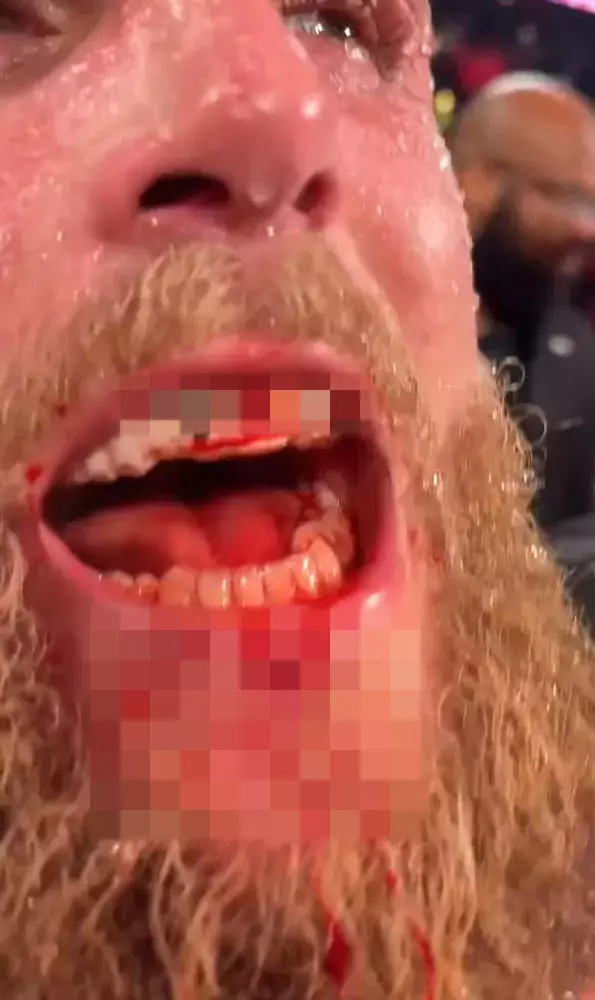 Anthony Joshua Jake Paul'un çenesini kırdı