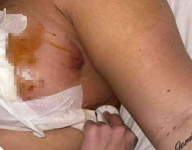 Göğüs dikleştirme operasyonu geçiren İngiliz modelin göğüs uçları çürüdü