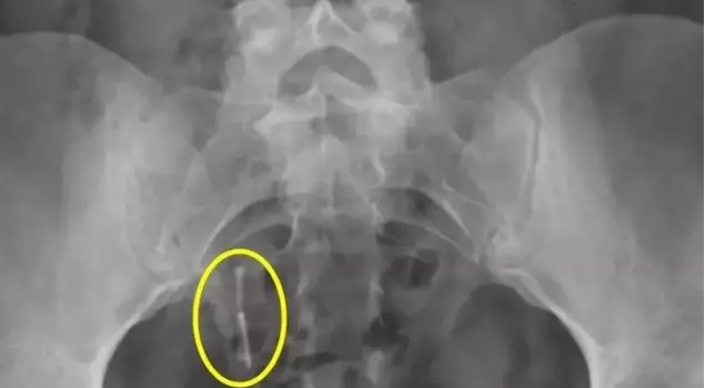 A birth control device lost by a woman named Daniella Hampton was found in her rectum 12 years ago in England.