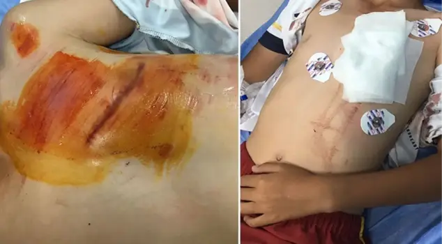 The exposed construction iron got stuck in the chest of the little child.