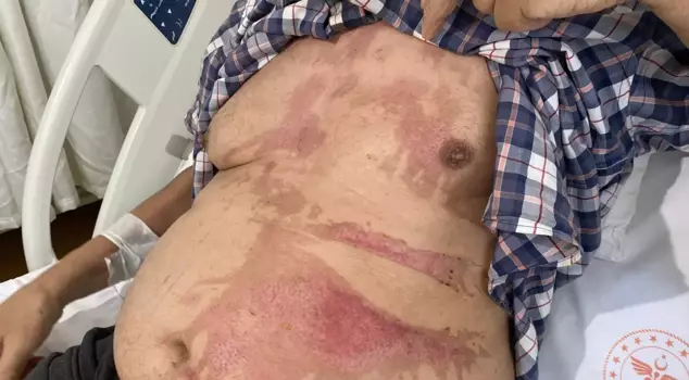 The old man became a victim of a sink opener: 40% of his body got burned.