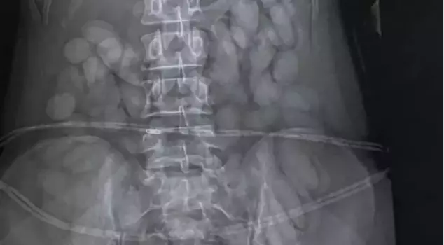 A woman was arrested in South Africa with a large number of drug capsules in her stomach.