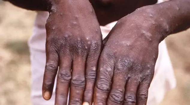 The first cases of monkeypox have been detected in Zimbabwe and Zambia.