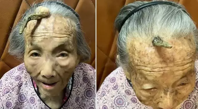 A 107-year-old woman in China has developed a horn on her forehead.