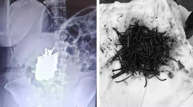 A 1-kilogram metal object was removed from a woman's stomach.