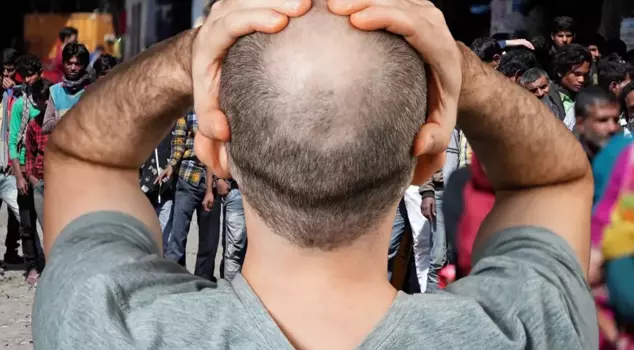 Due to a new virus that emerged in India, 155 people suddenly became bald.