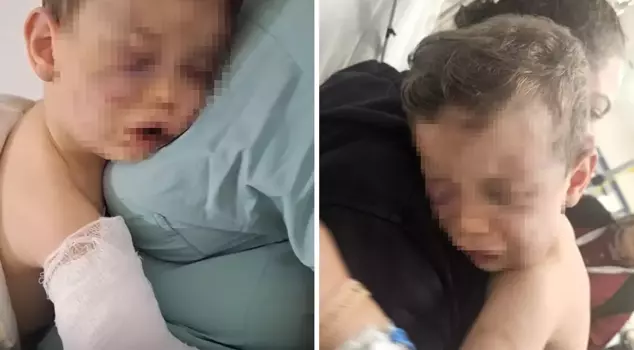 They tried to burn baby Aren, who was brutally beaten by his mother's boyfriend.