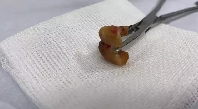 In his sleep, he swallowed his teeth and rushed to the hospital with an unbearable cough.
