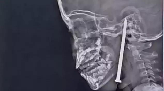 The little girl who had a nail lodged in her brain was miraculously saved.