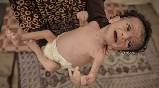 In the last 24 hours, 6 more people have died of hunger, and 7-month-old baby Salim's life is in danger.