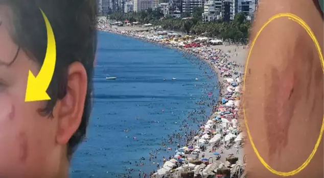 Citizens are uneasy! Those who swim in the sea are coming out with burns.