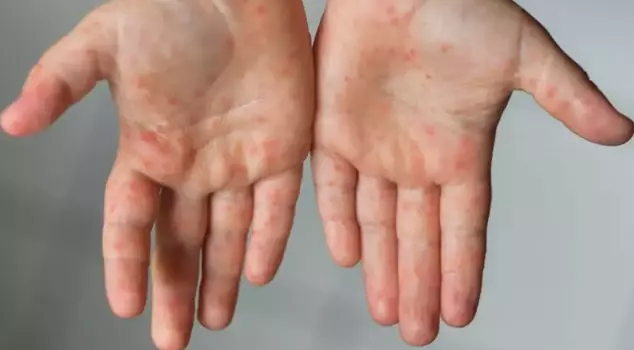 In Indonesia, 17 people have died due to a measles outbreak.