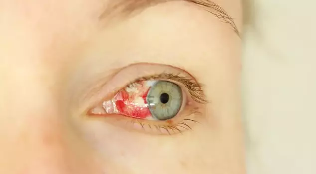 A mysterious outbreak starting with eye bleeding is spreading: 8 dead.