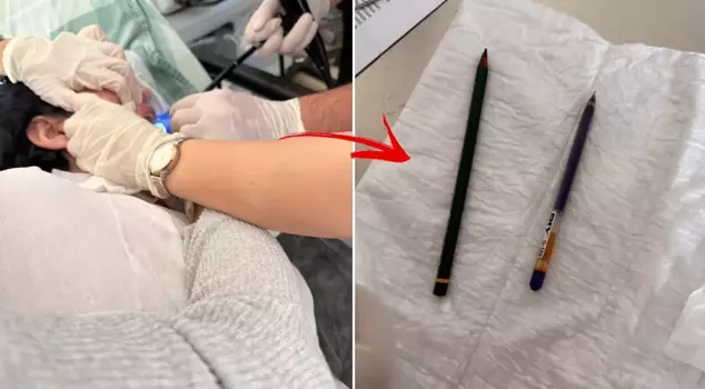 The young woman had two pens removed from her stomach.