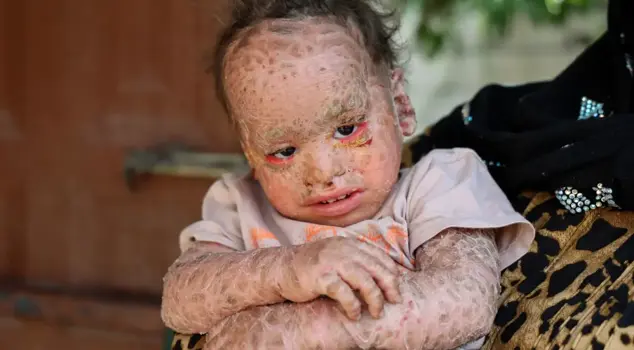 They stole photos of Yusuf, who has fish scale disease and butterfly disease, and committed fraud.