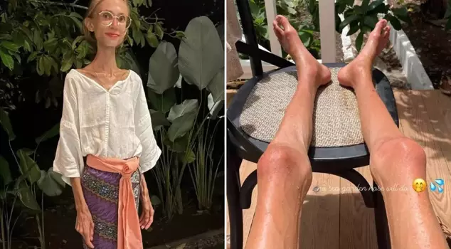 A social media influencer who lost up to 20 kilograms on a fruit diet has passed away.