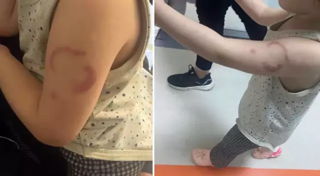 Serious allegation at private preschool: Teacher bit the arm of a 3-year-old child.