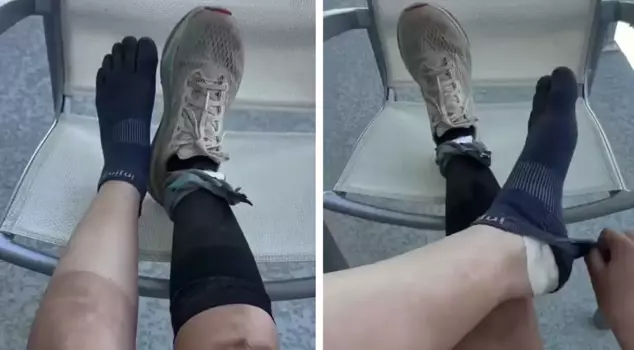 The condition of the runner's feet after running 160 kilometers is incredible.