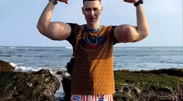 Russian Captain Nemo's arms are in danger: Dangerous injections have led to a severe infection.